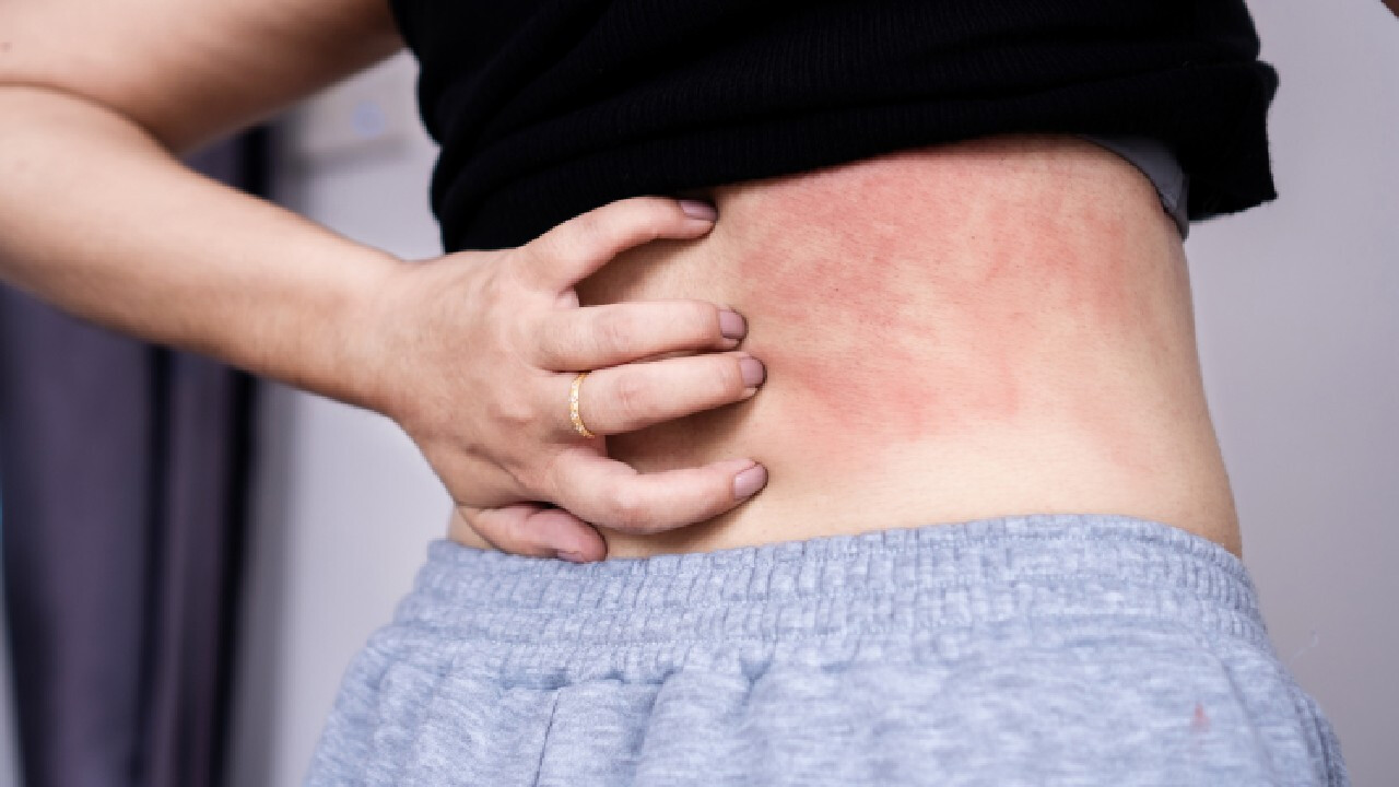 Az atópiás dermatitisz felismerése és kezelése – tippek és tanácsok