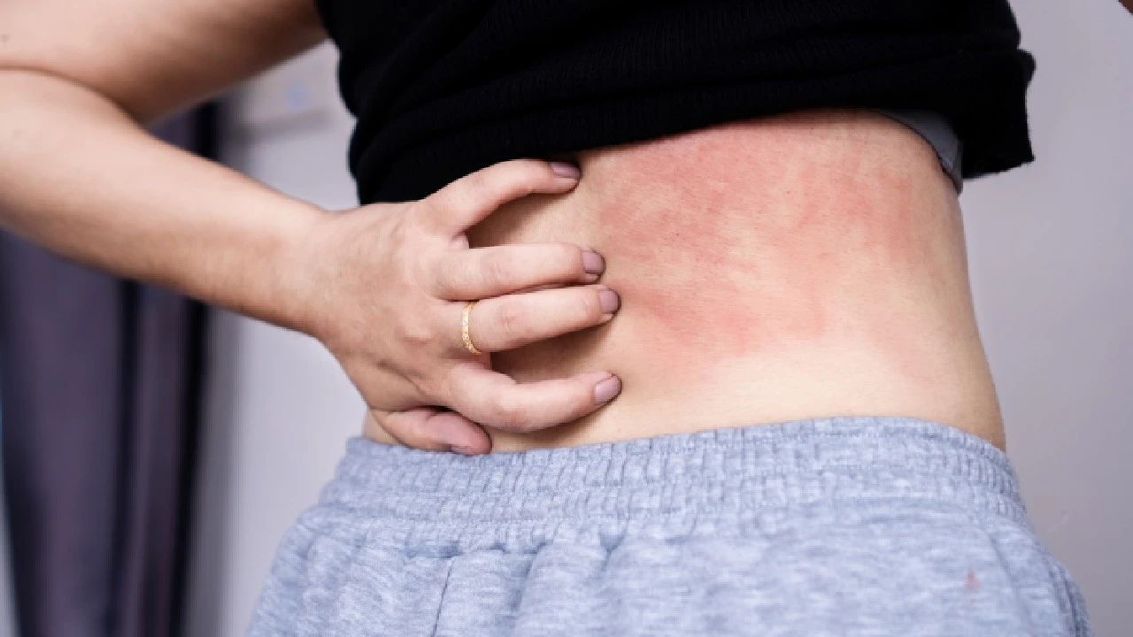 Az atópiás dermatitisz felismerése és kezelése – tippek és tanácsok