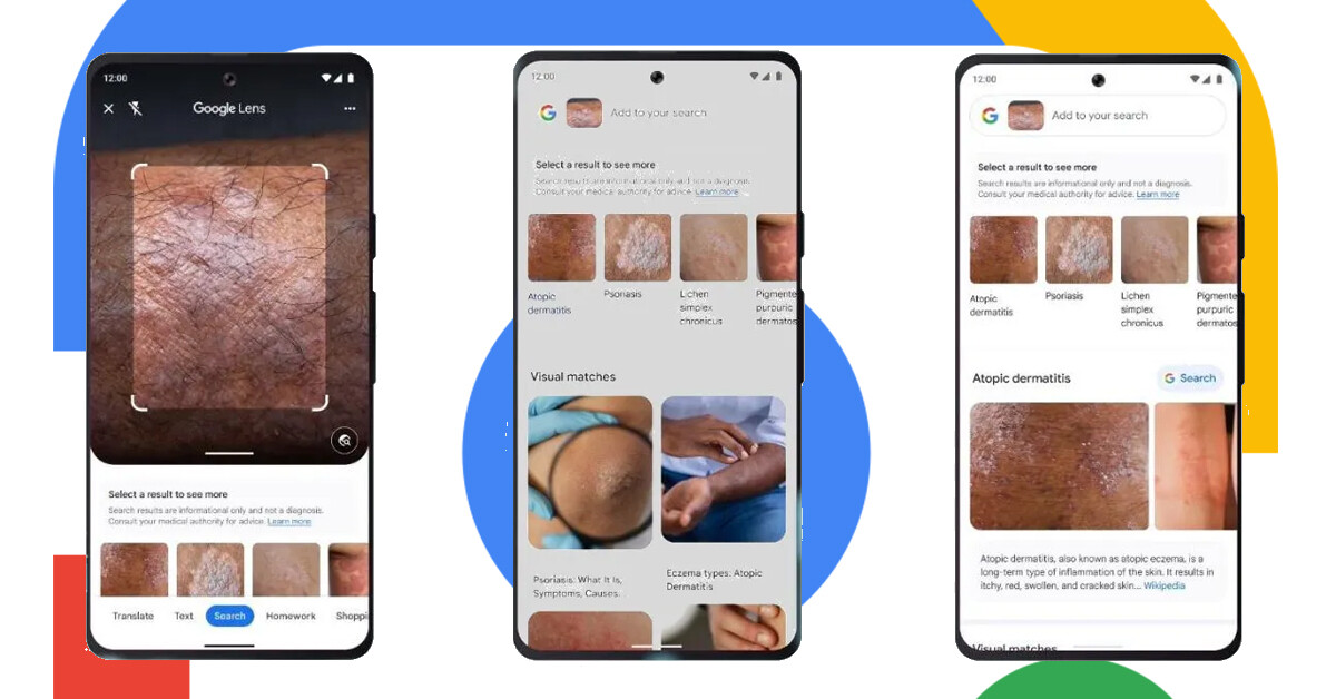 Hamarosan ráguglizhatunk, ha gyanúsnak találjuk anyajegyünket