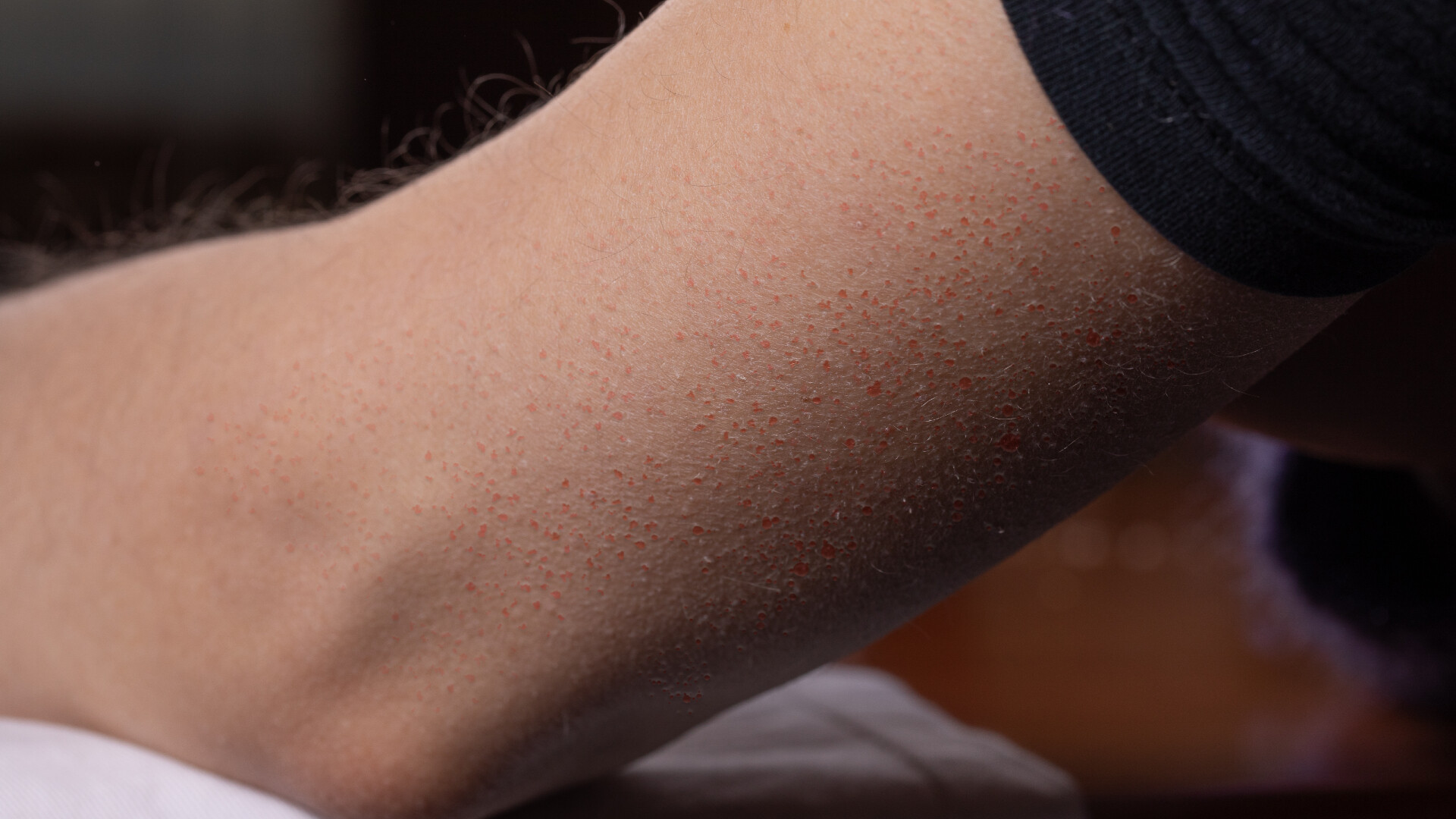 Lúdbőr, libabőr, eperbőr: mit érdemes tudni a keratosis pilarisról?