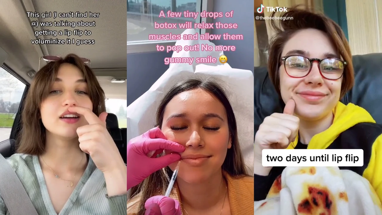 A botoxos ajaknagyobbítás az új TikTok divat, megkérdeztük a plasztikai sebészt, mit várhatunk tőle